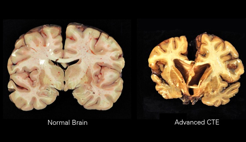 Regular+Brain+vs+CTE+Brain